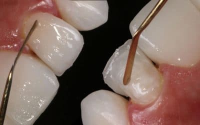 Facetas dentais na recuperação e aprimoramento dos sorrisos