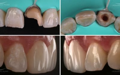 Dentes escuros e o tratamento endodôntico: cuidados e resultados clínicos