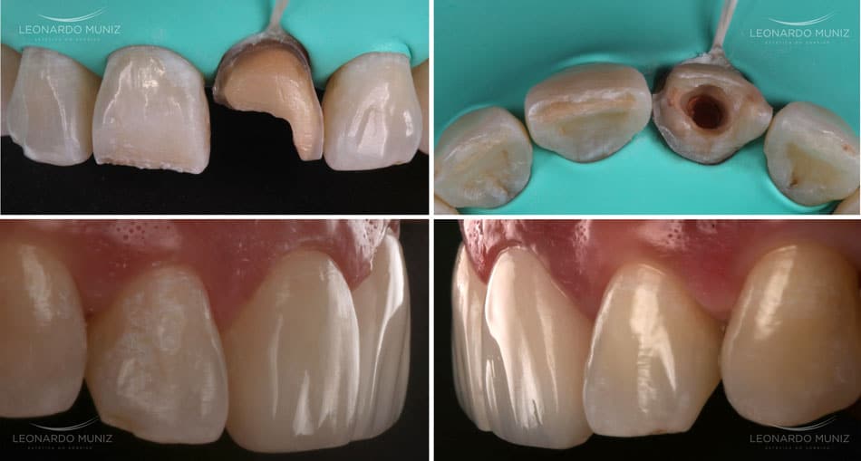 Dentes escuros e o tratamento endodôntico: cuidados e resultados clínicos